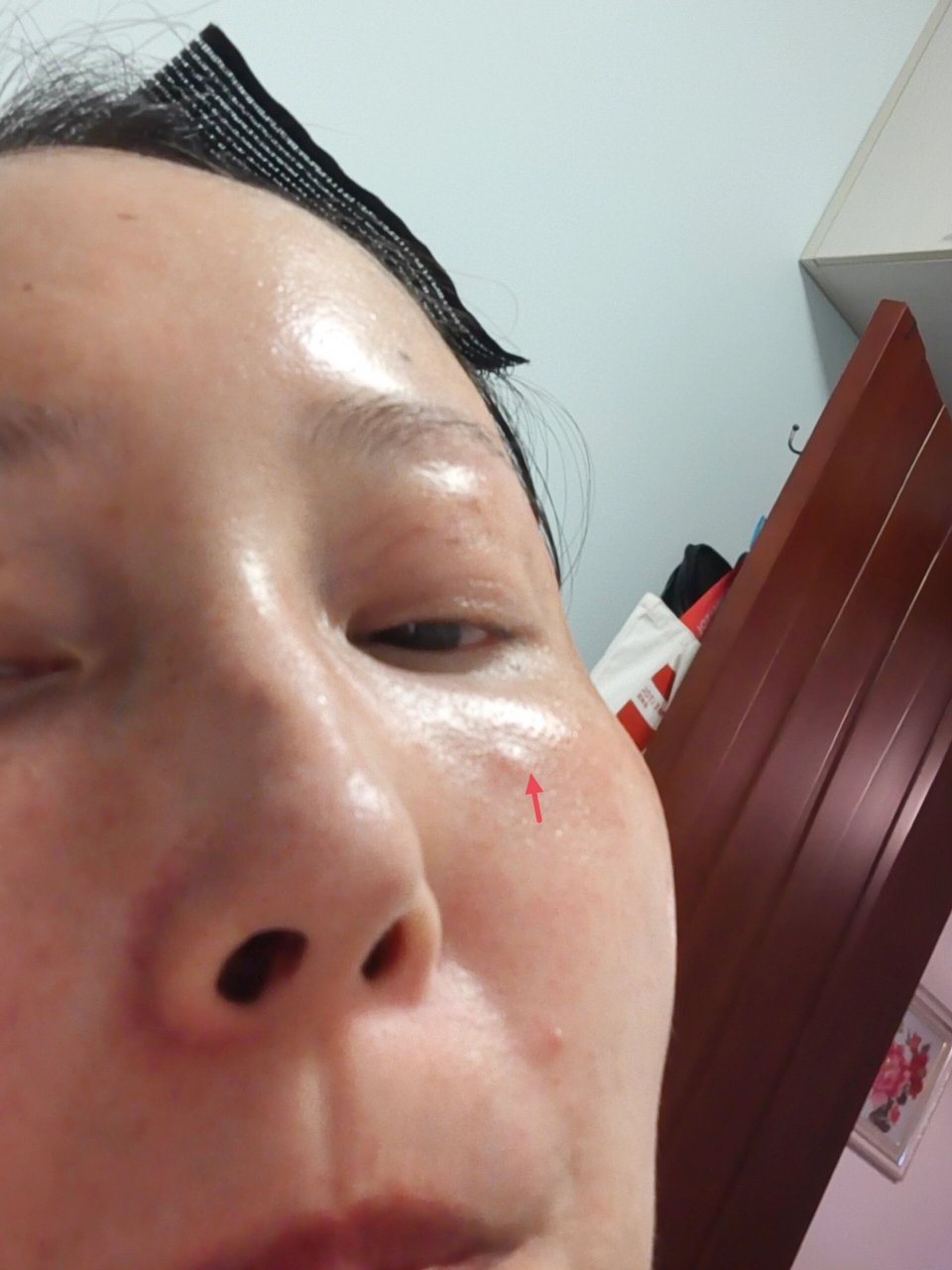 面部皮下的小疙瘩是什么?