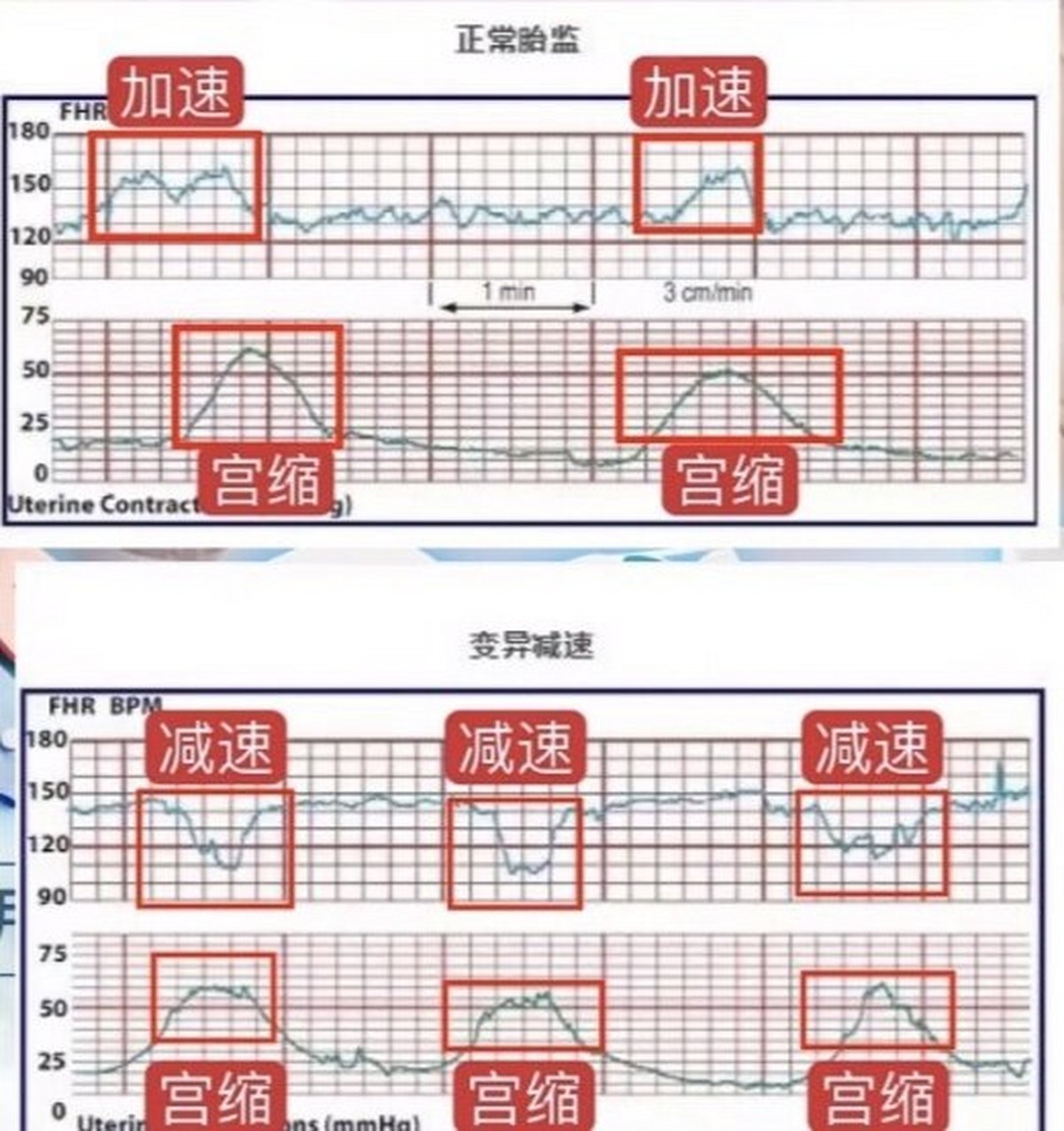 规律宫缩胎监图图片