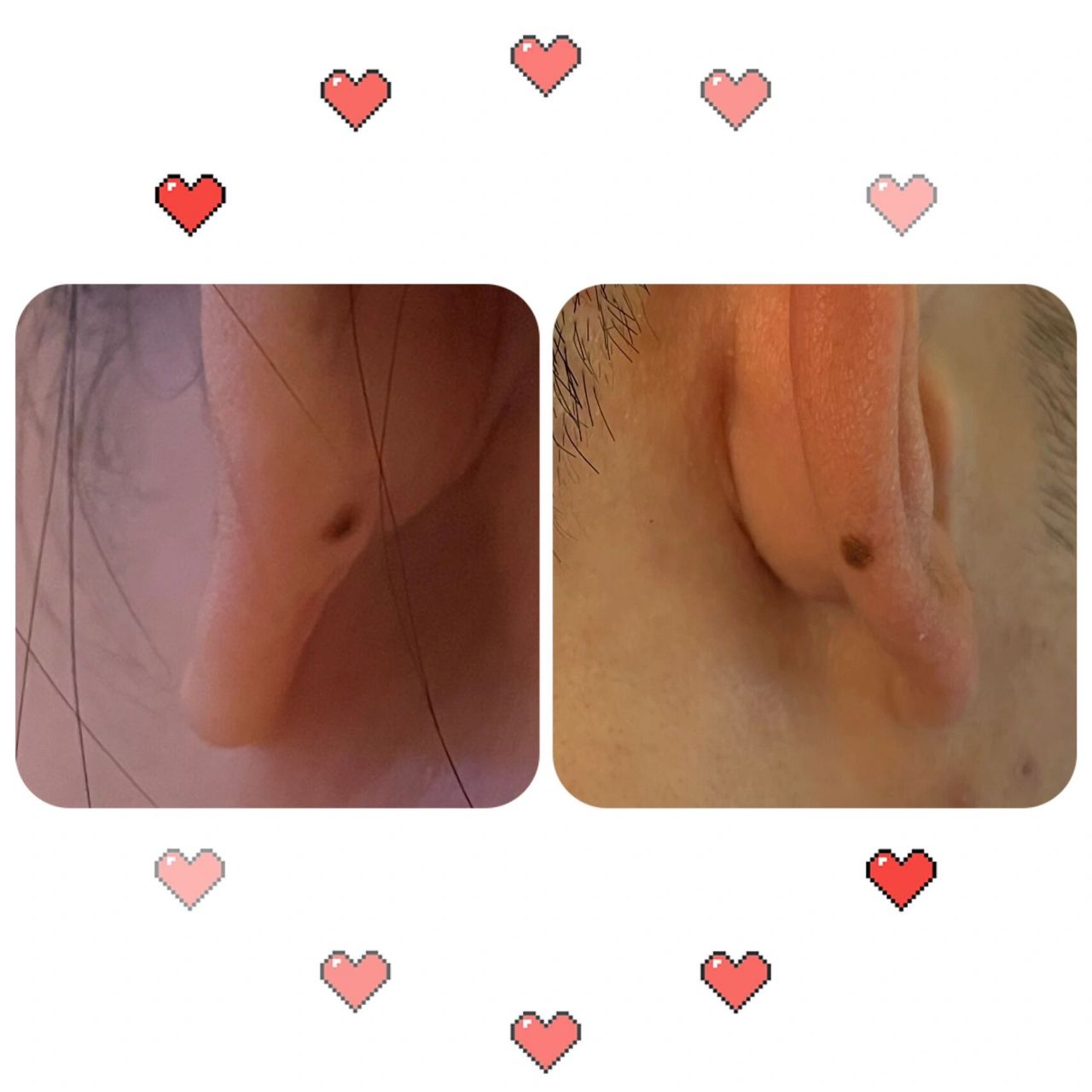 耳轮上的情侣痣 亲子痣06 妈妈左耳痣,爸爸右耳痣,宝宝左耳痣