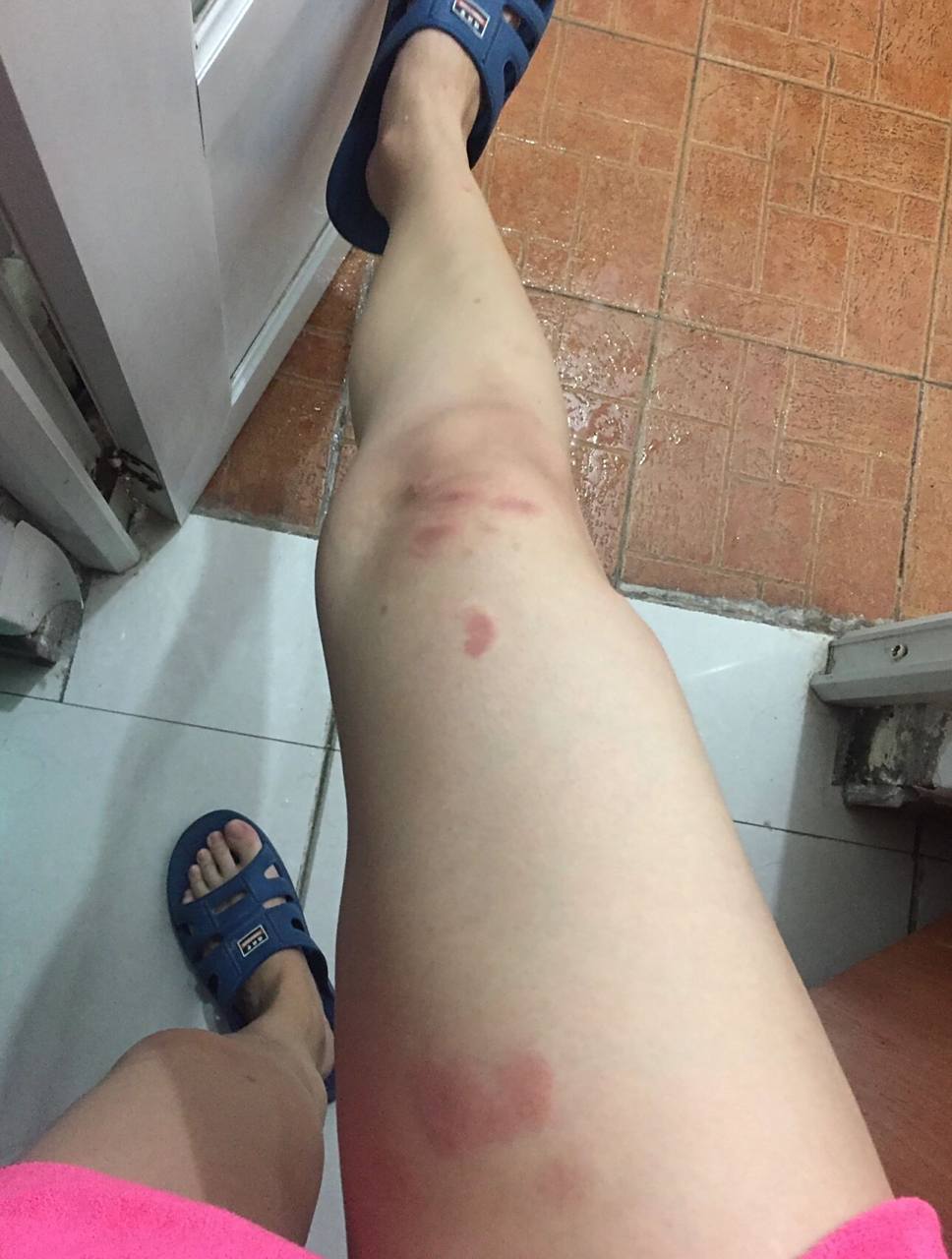 大漆过敏怎么办?