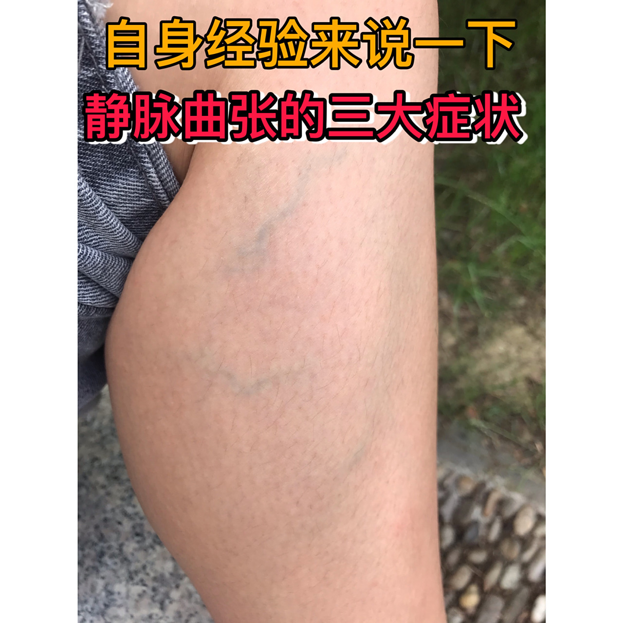 7515 16615腿部有水肿 女性下肢静脉曲张惹起脚踝足背水肿