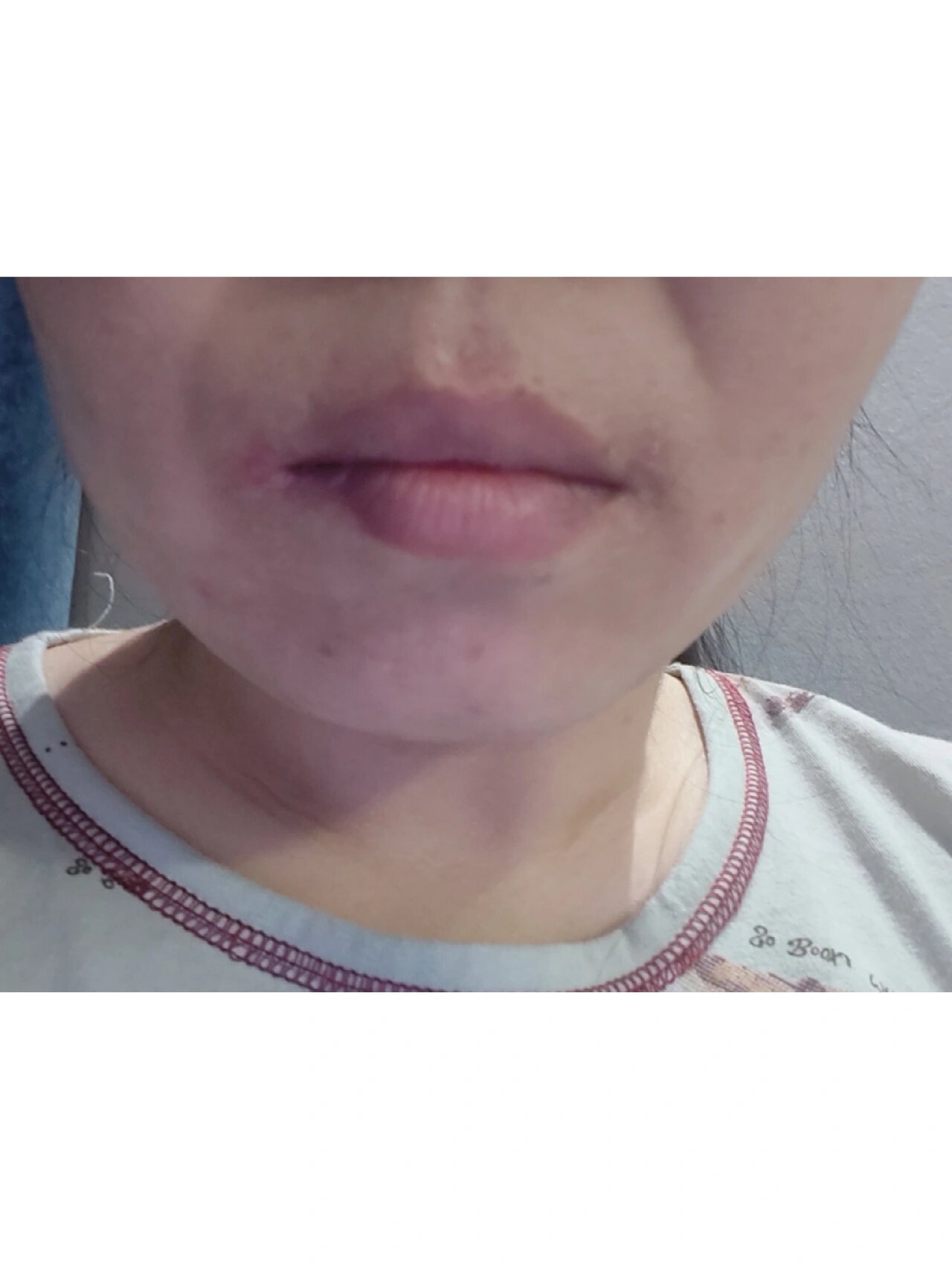 嘴周围红,痒,刺痛,爆皮