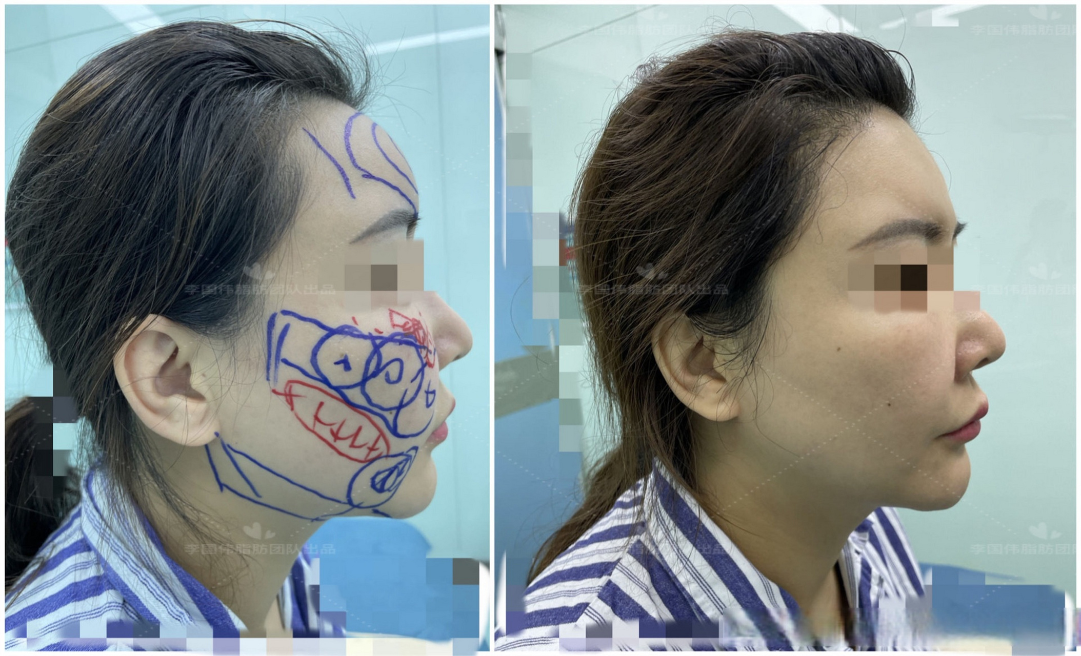 姑娘做过两次面部#自体脂肪填充#后整个额头非常饱满,呈"寿星公头"