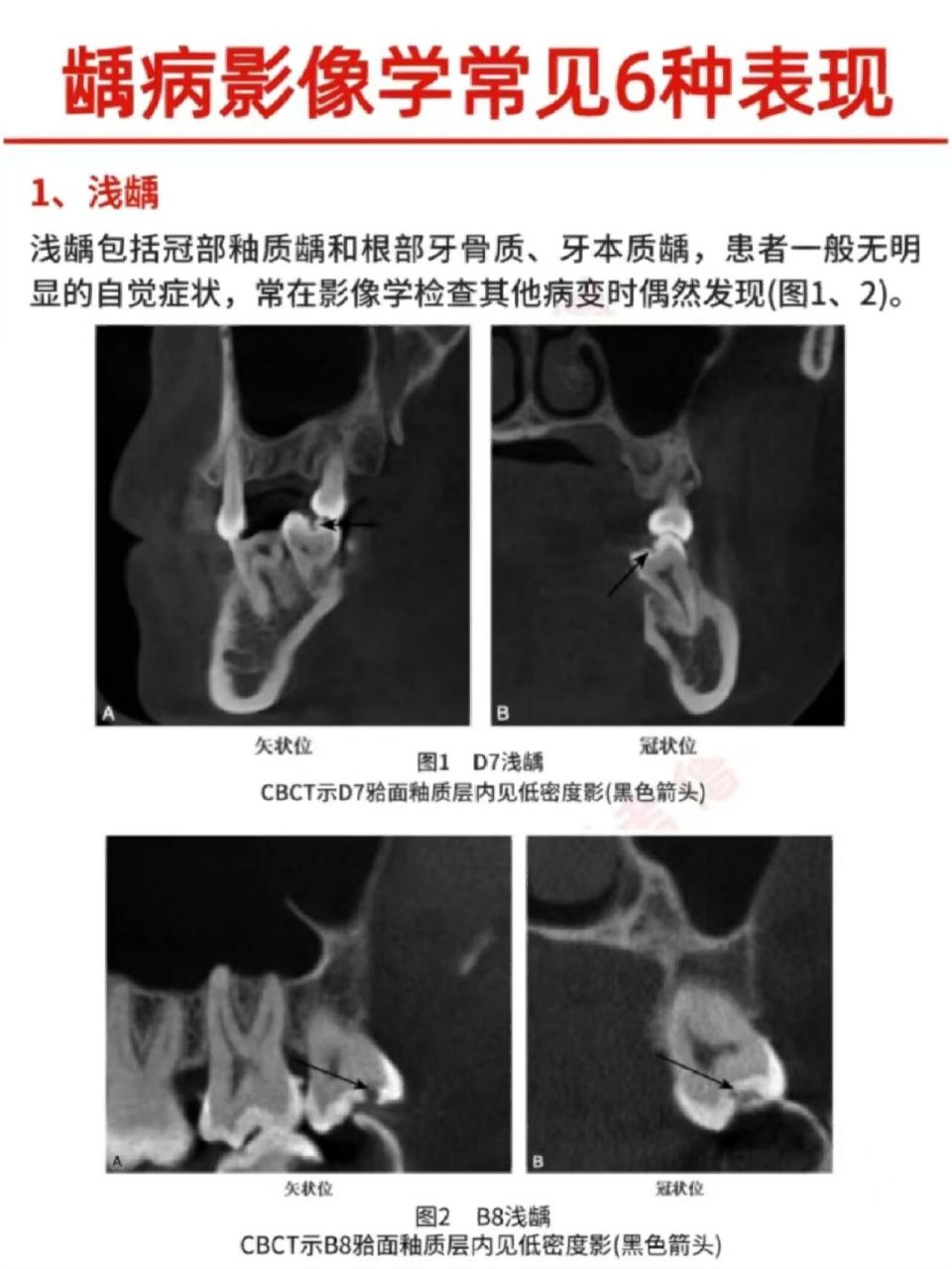 蛀牙x光片图片