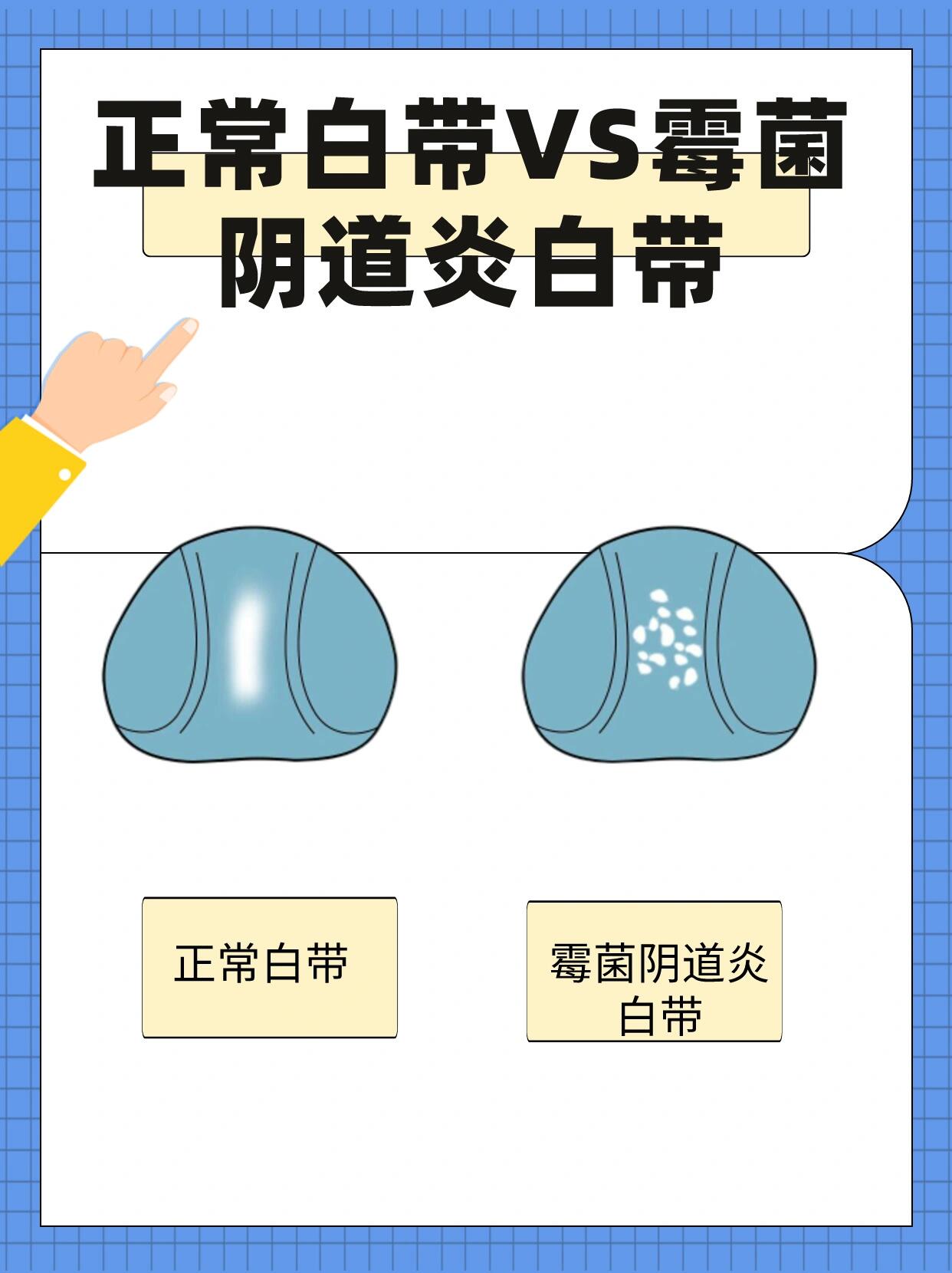 94正常白带vs霉菌阴道炎白带对比95 白带是一种正常的生理现象