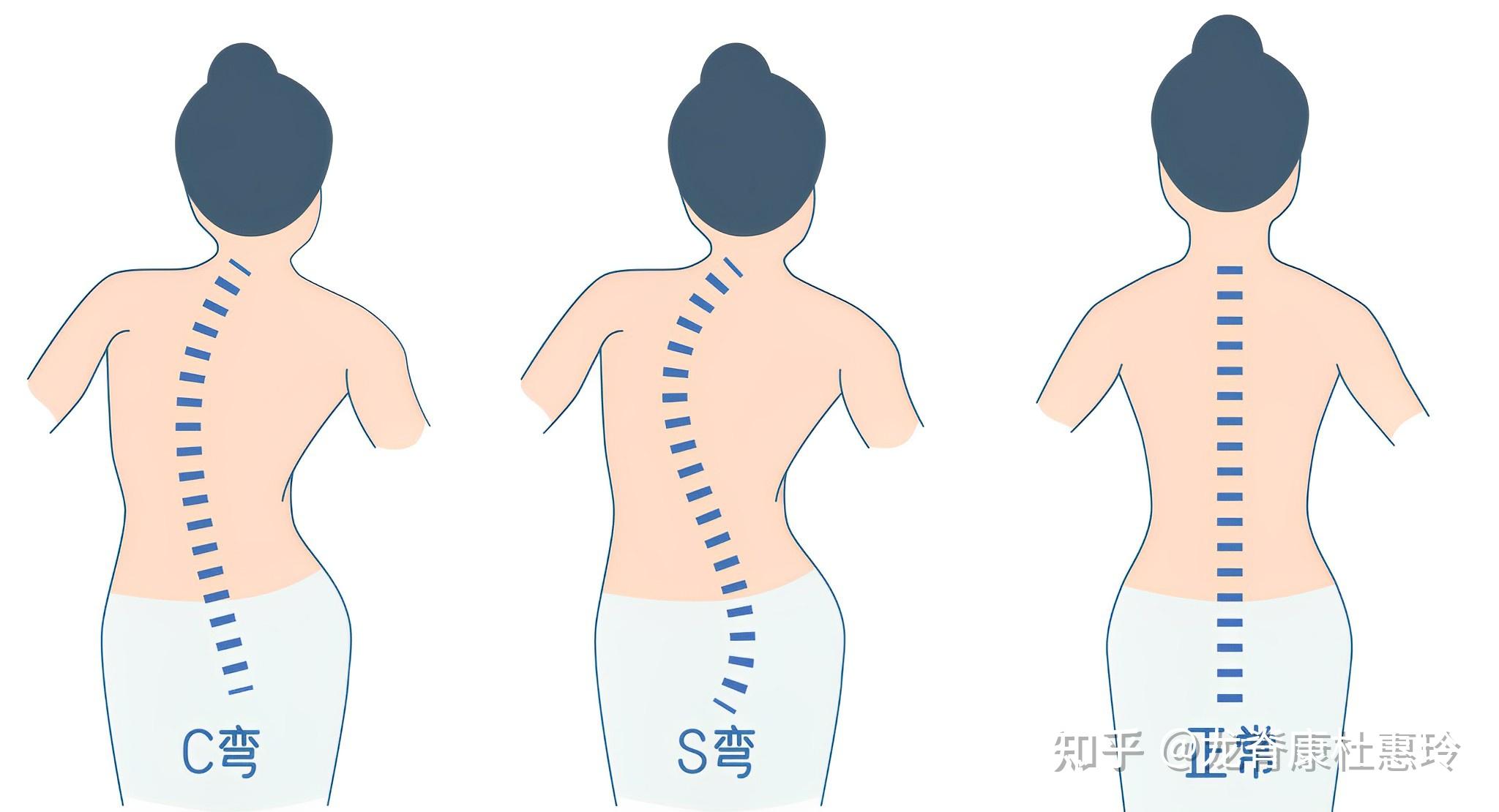 后背脊柱左侧肌肉鼓包图片