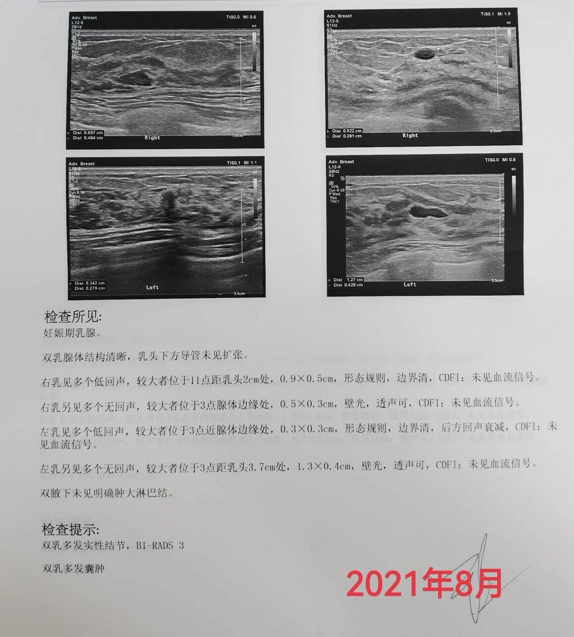 乳腺结节4a