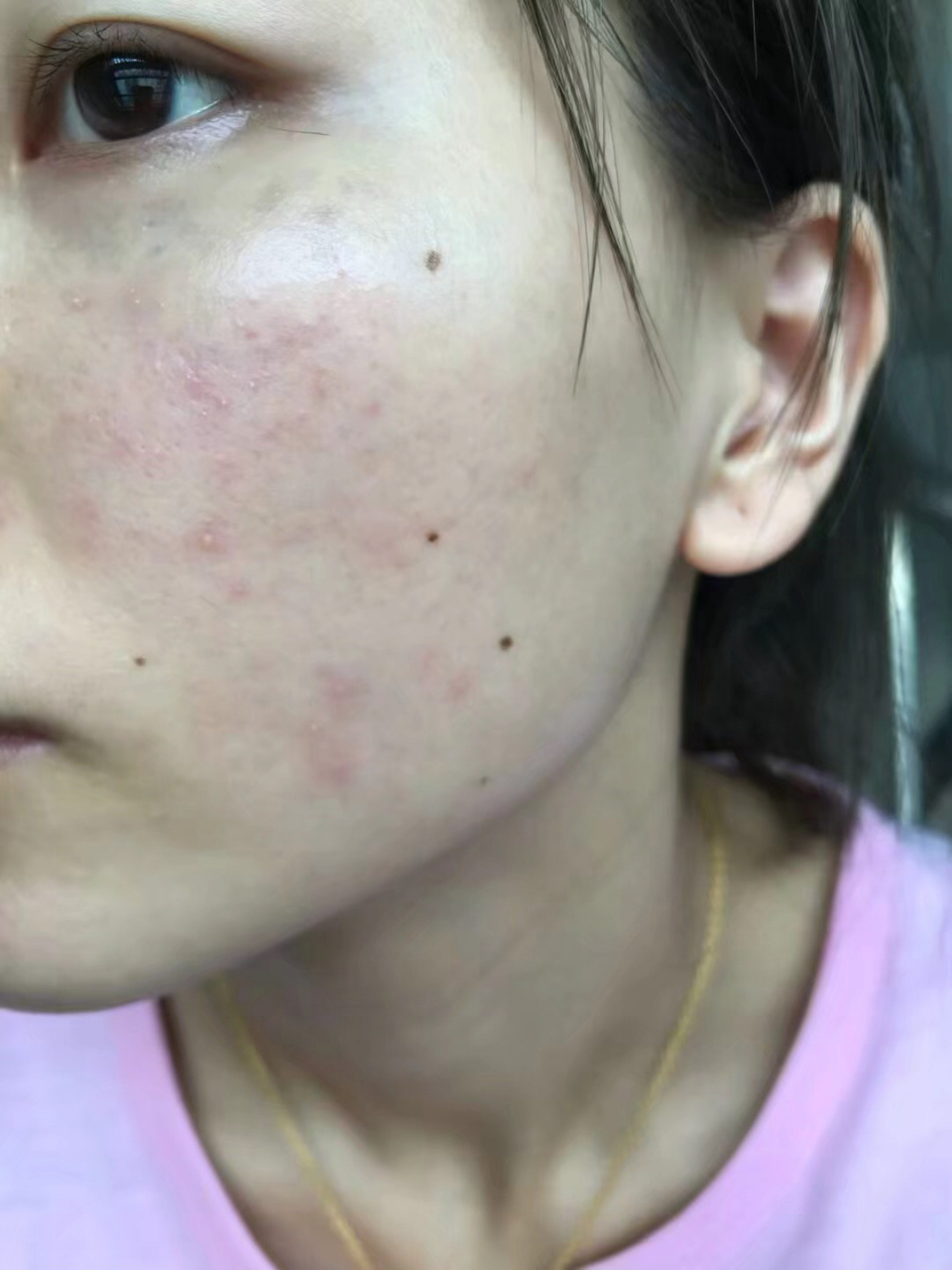 玫瑰痤疮,最严重的爆发期 图一为第一次正规治疗前,2018年七月.