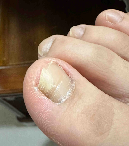 脚趾甲出现横纹,凹凸不平可能由多种原因引起