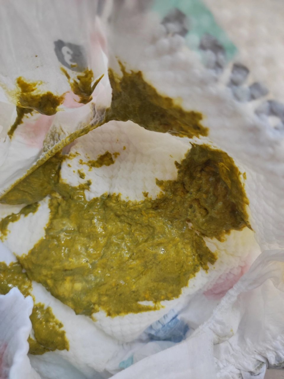 深度水解奶粉蔼儿舒第3天  总量:(奶液量)910 80 大便:3次 今天40ml一