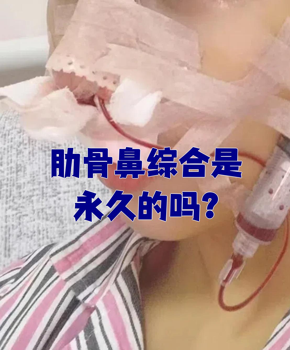 肋骨鼻综合是永久的吗?
