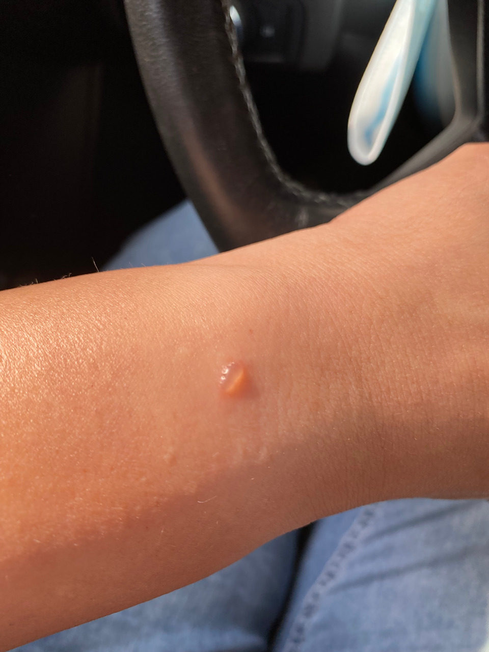 苹果手表直接把人胳膊烫了一个水泡,太离谱了[捂脸]