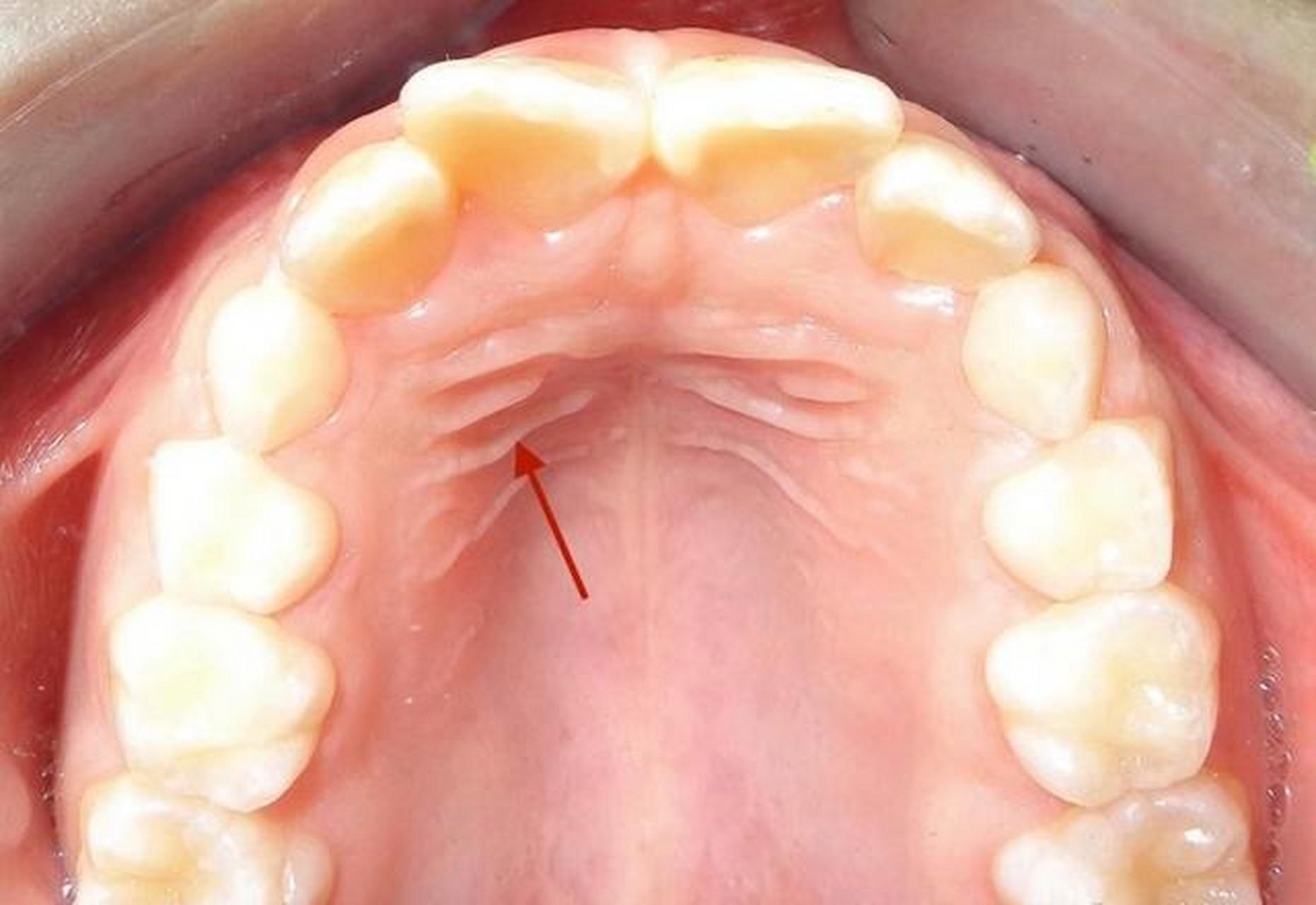 正常人口腔上颚图片图片