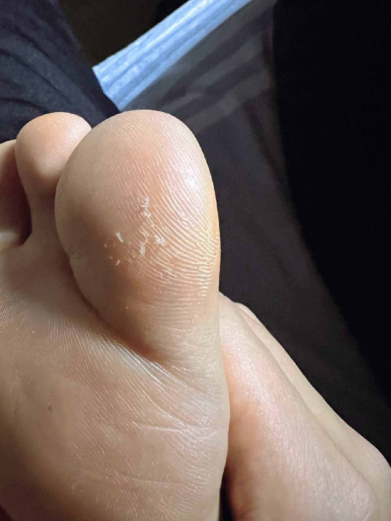 生完娃后,大母脚趾倒刺 很奇怪,之前都没有,就从孕晚期开始,一直到