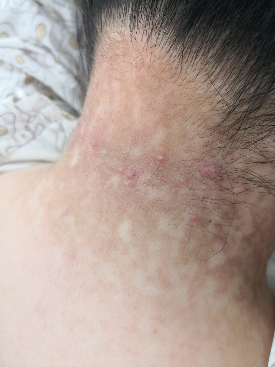 颈周腋下乳房下的黄褐色斑片#解决皮肤问题专注皮肤美