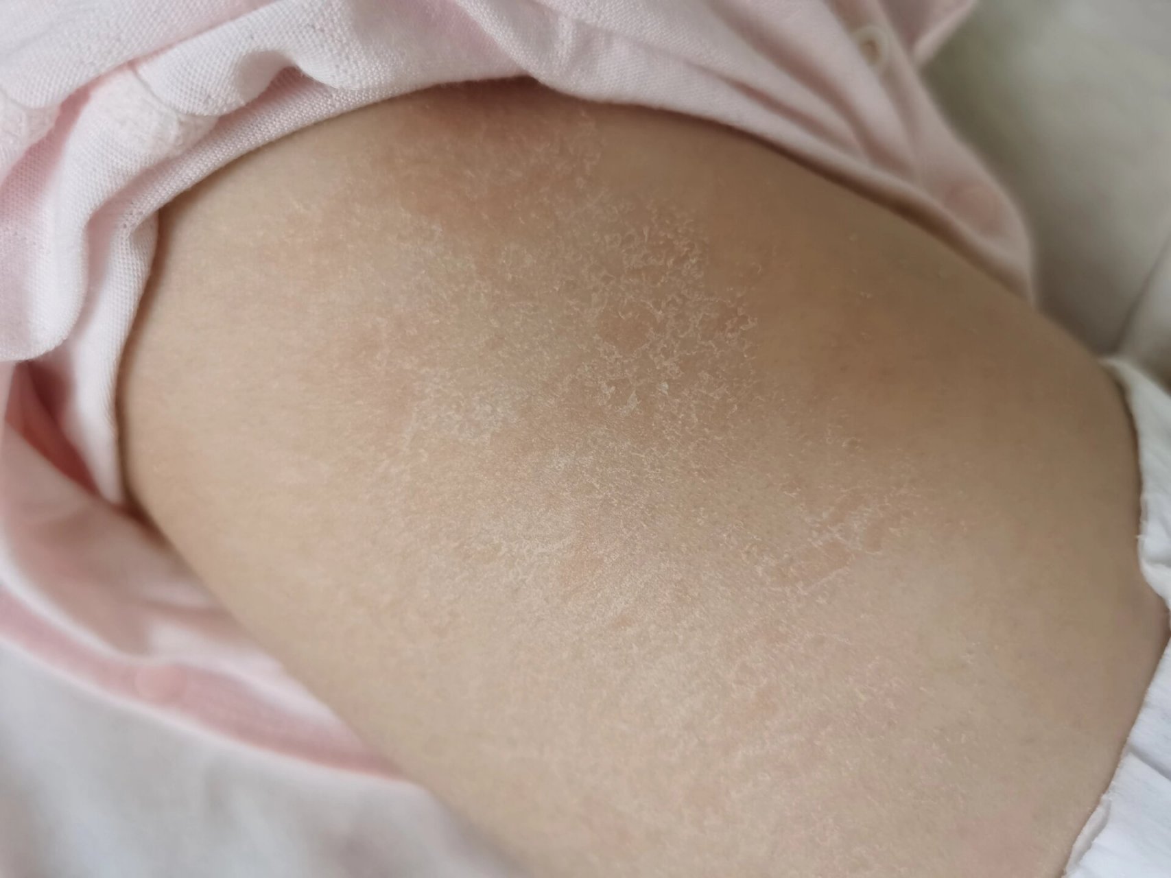 宝宝背上起皮好干,为啥 71天宝宝最近后背脱皮严重,每天晚上洗澡后都