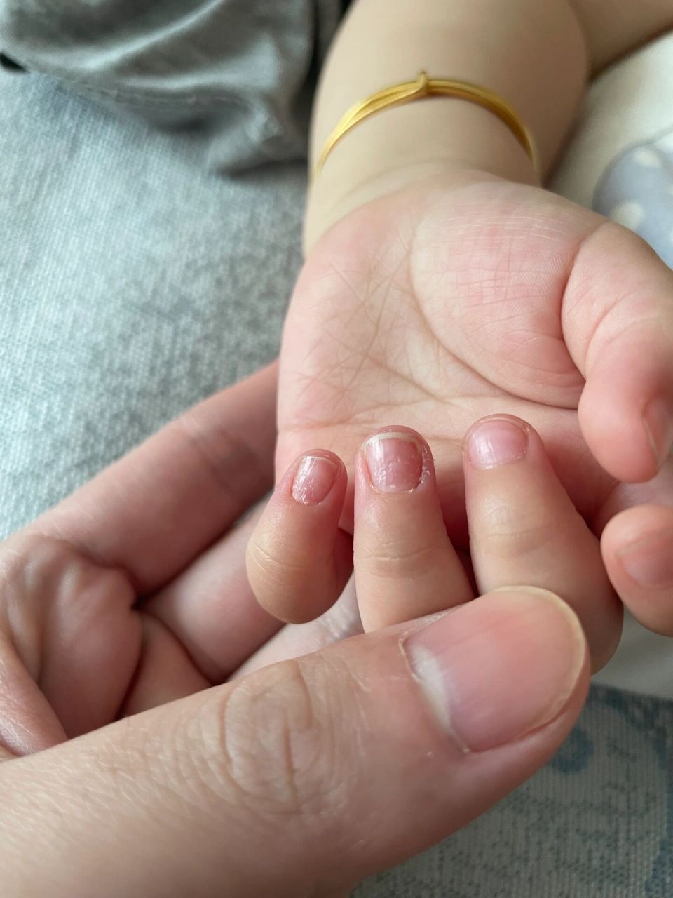 宝宝指甲面凹凸不平 有姐妹知道是怎么回事嘛?