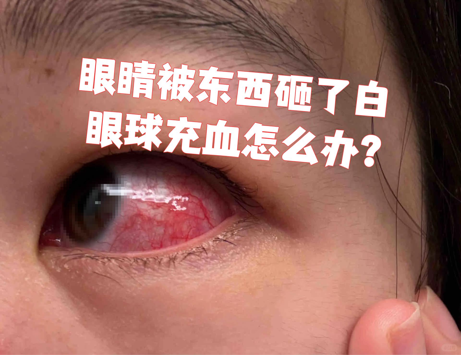 眼睛被东西砸了白眼球充血怎么办?