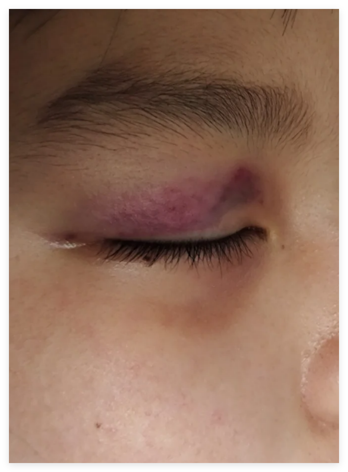 额头淤青扩散到眼睛通常是不正常的