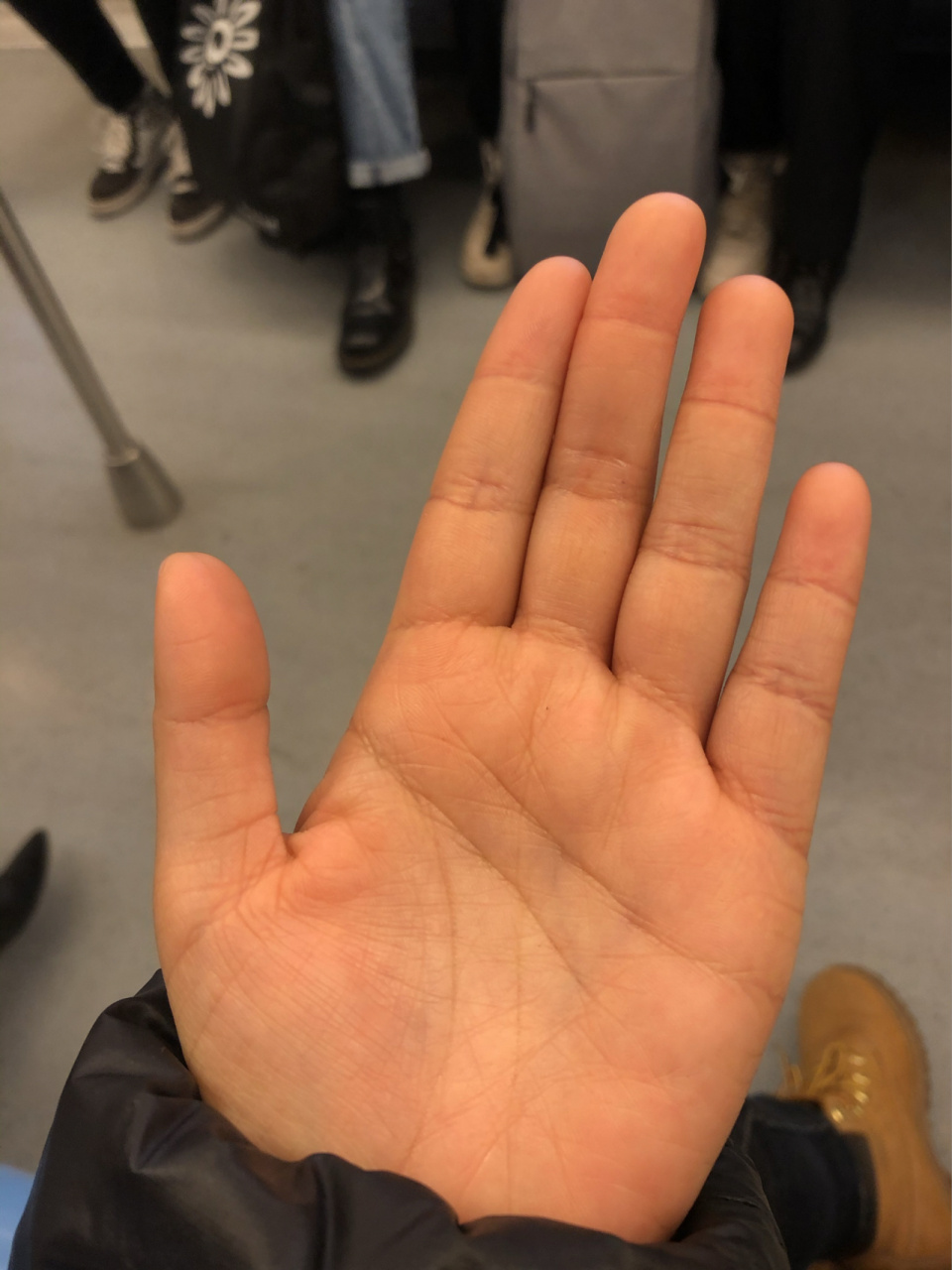 终于找到我手心发黄的原因了 今年体检后专门去做了贫血的分析,还是