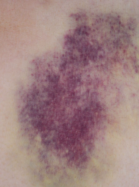 大腿出现紫色淤血斑块,常见原因有这几种: