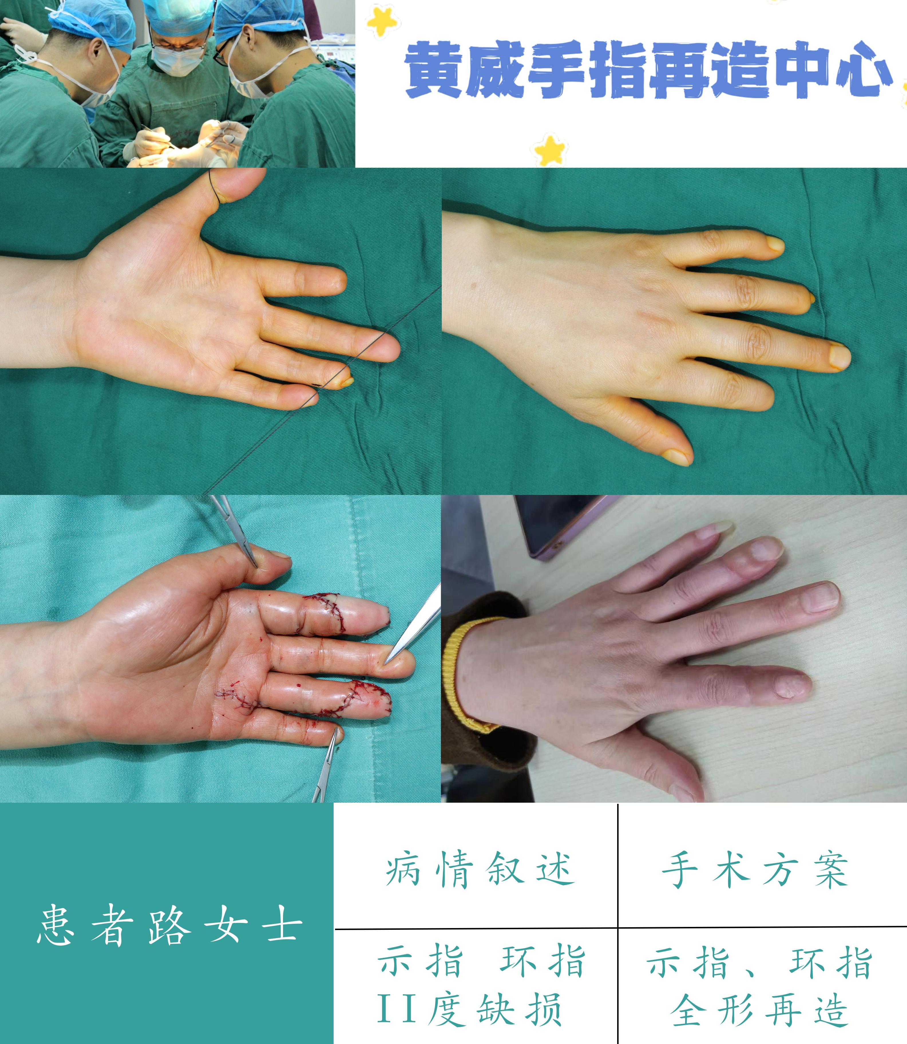 手指畸形求问知乎里医生朋友们我这能矫正吗