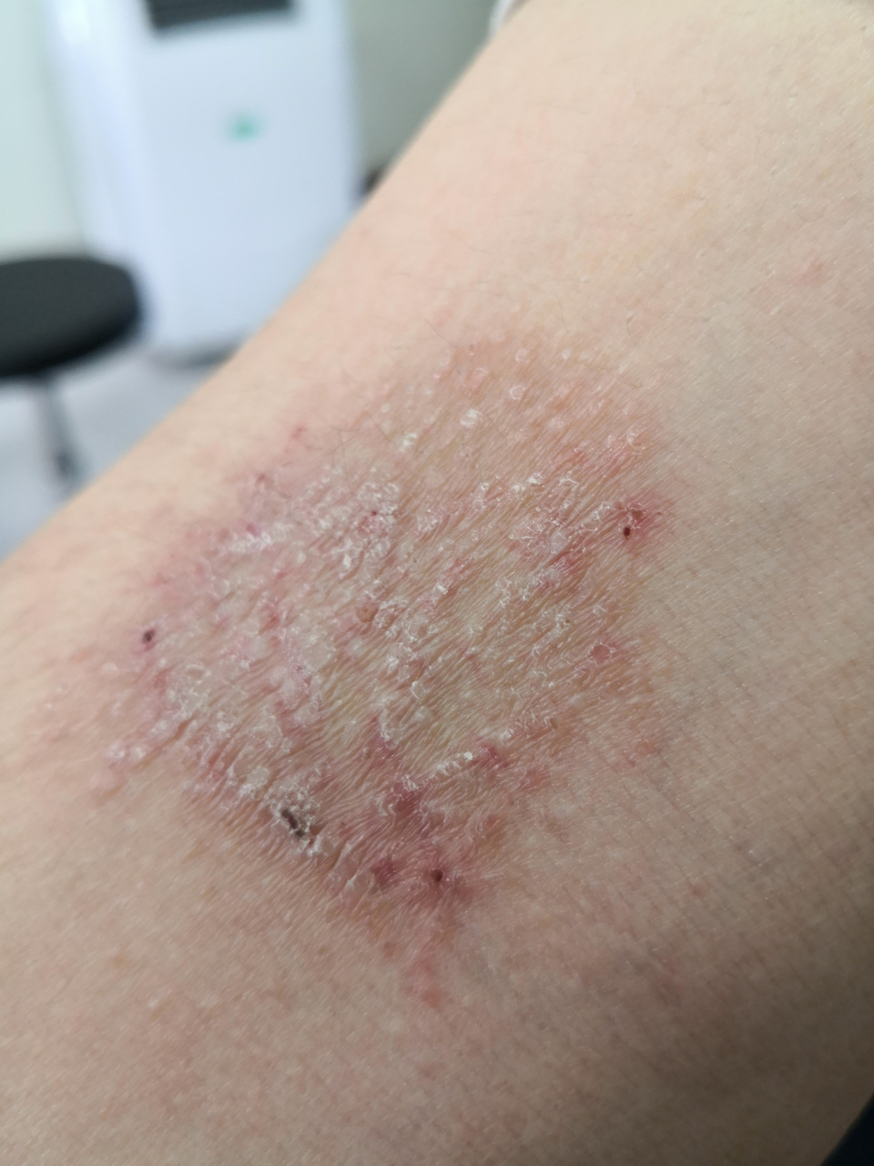 肘部和颈周苔藓样变皮疹.