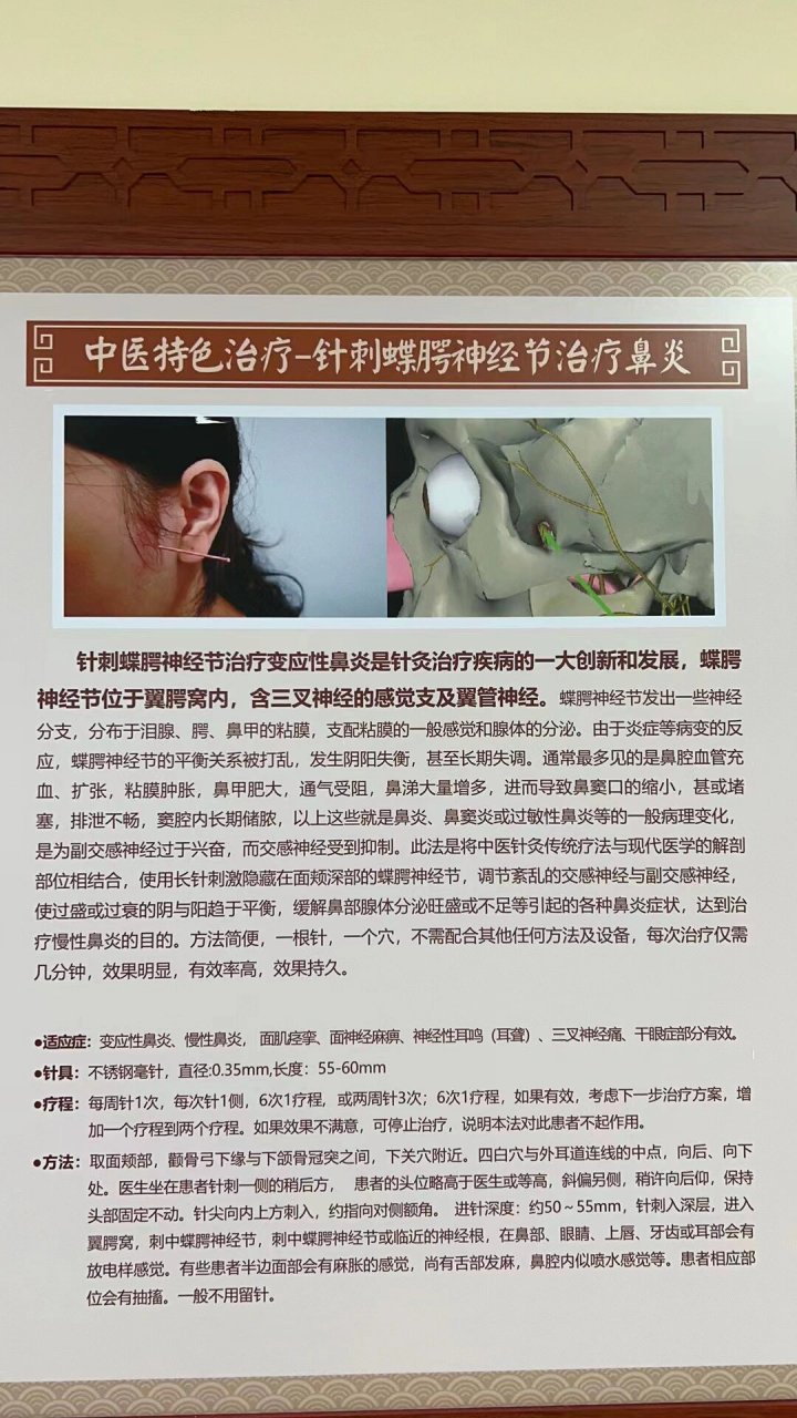 针刺蝶腭神经节治疗 第二次 刺的一瞬间鼻子通了 但是又慢慢堵回来