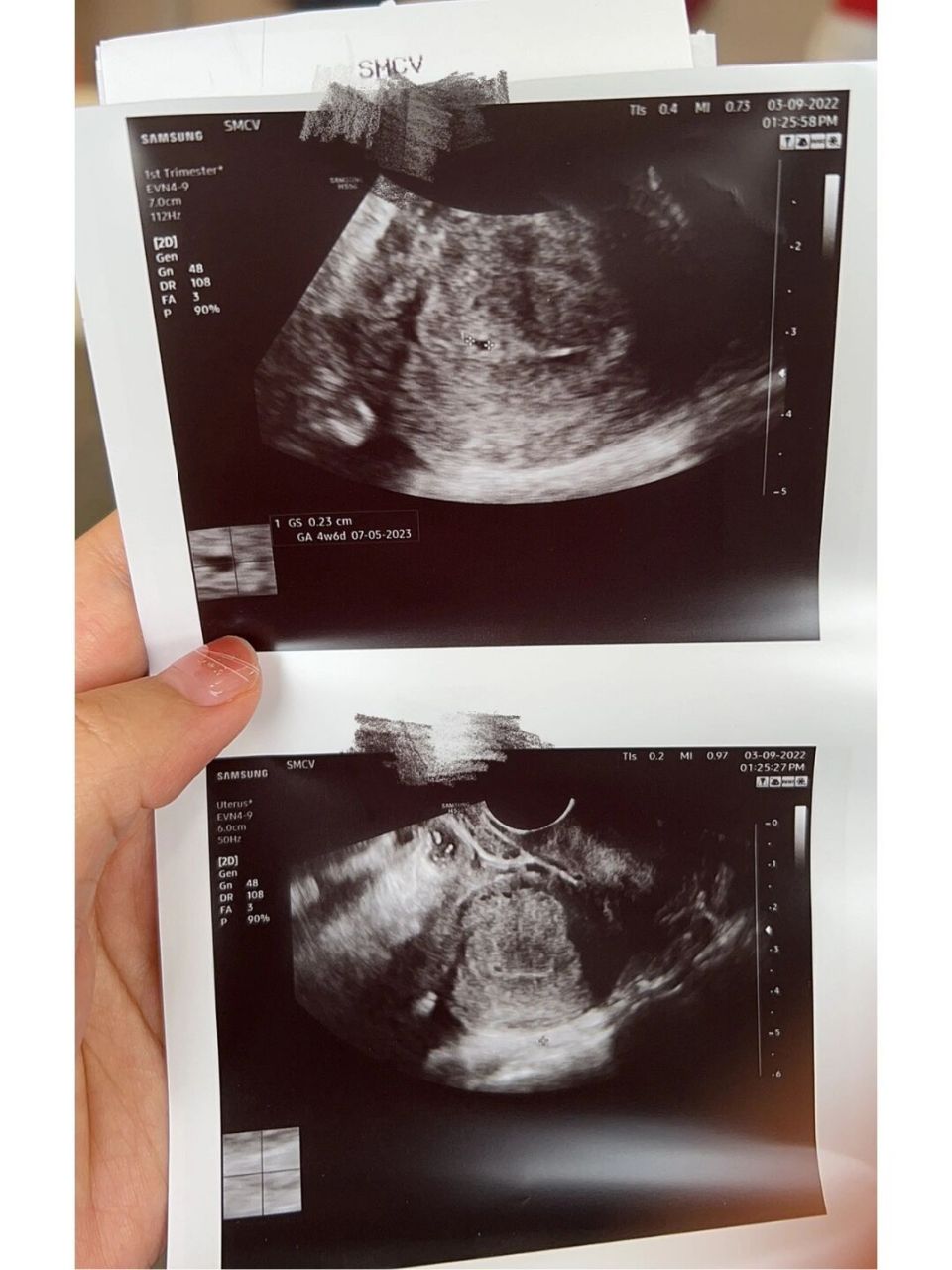 孕4周阴道超声检查,已经能看到宫内孕囊拉 第一次见到我宝了,好激动