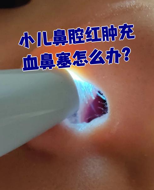 小儿鼻腔红肿充血鼻塞怎么办?