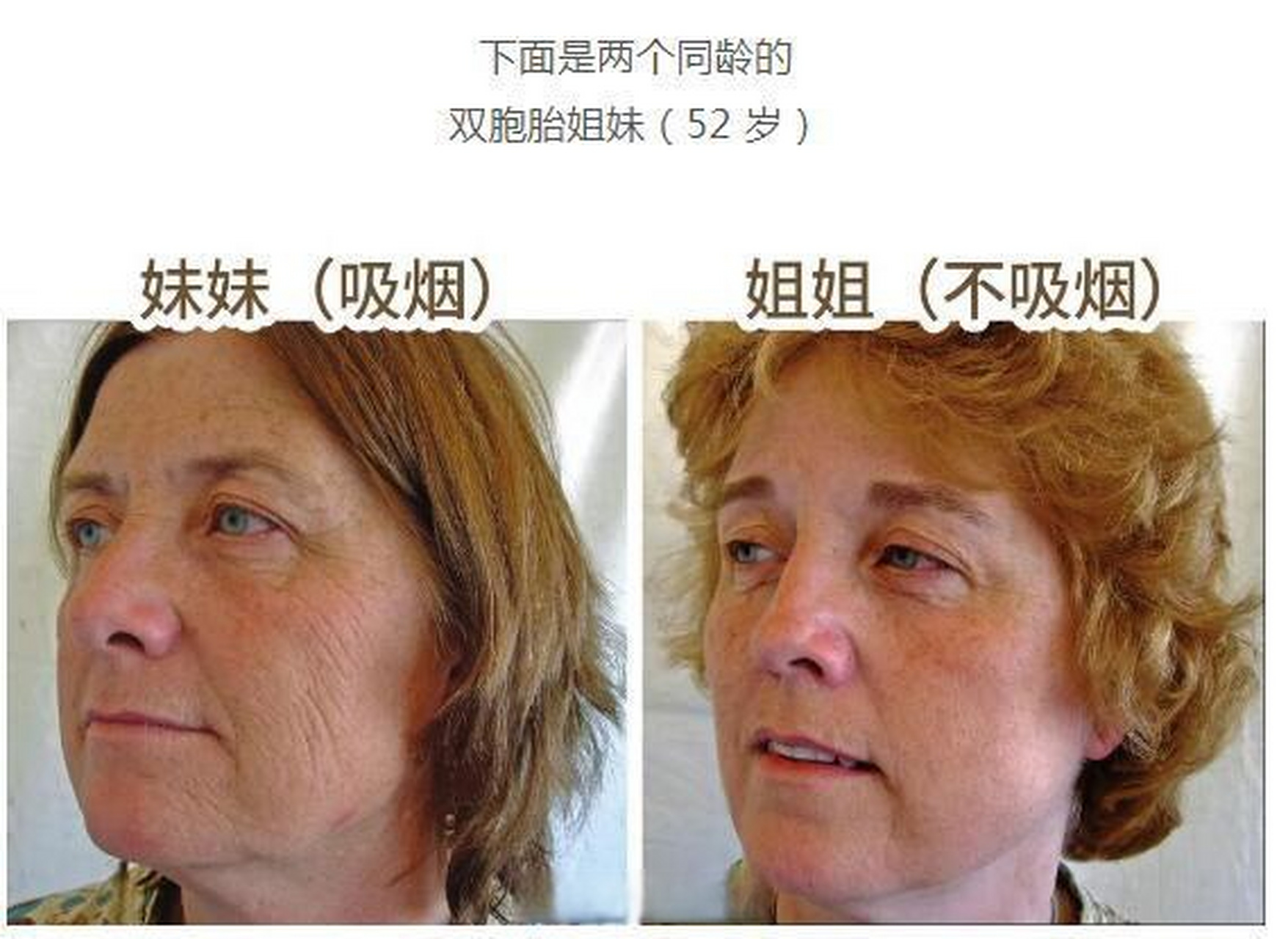 健康新知#【一项针对双胞胎的研究发现:#吸烟加快面部衰老#】#为何