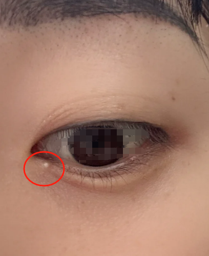 这种小白点经常长在眼睑,脸颊或额头,不痛不痒,一般不用特别处理