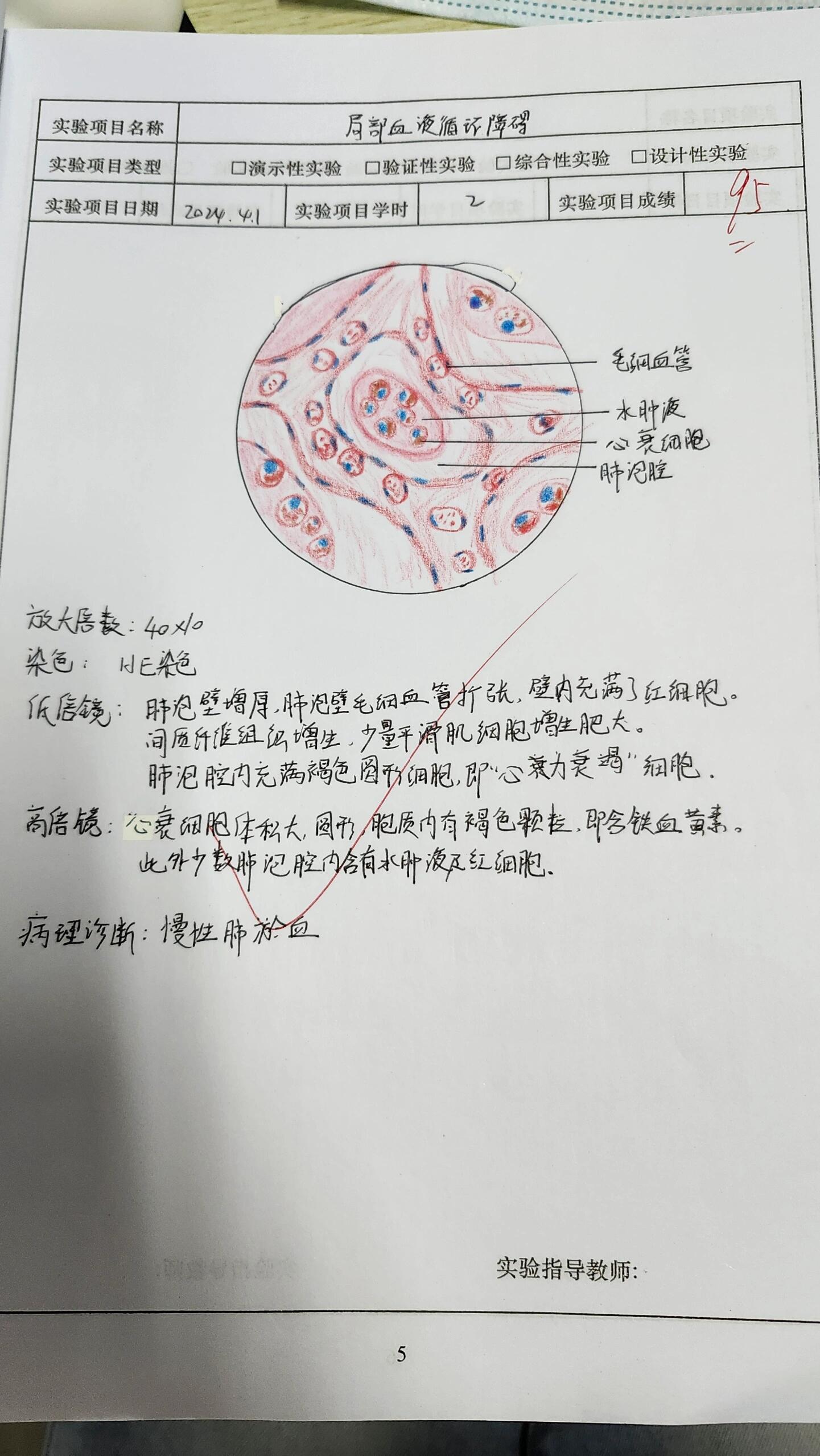 慢性肺淤血