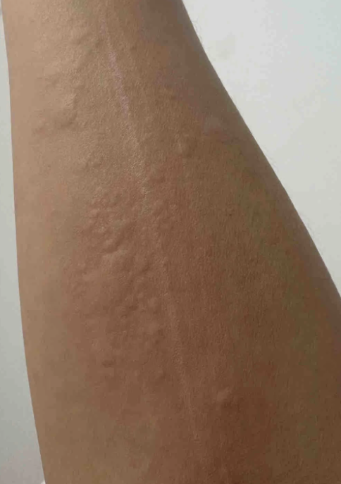 手臂上出现一小块密集的痒点,常见原因包括接触性皮炎,湿疹和荨麻 