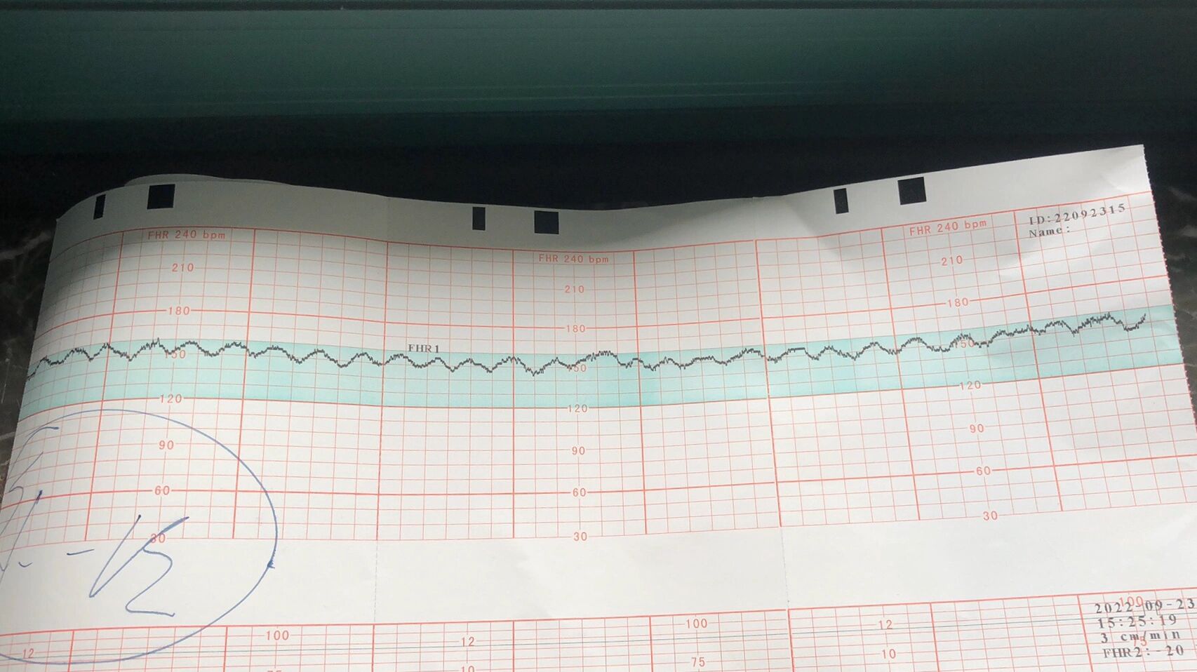 胎心正弦波 今天做了三次胎监 第一次加速不够 第二次出现正弦波 医生