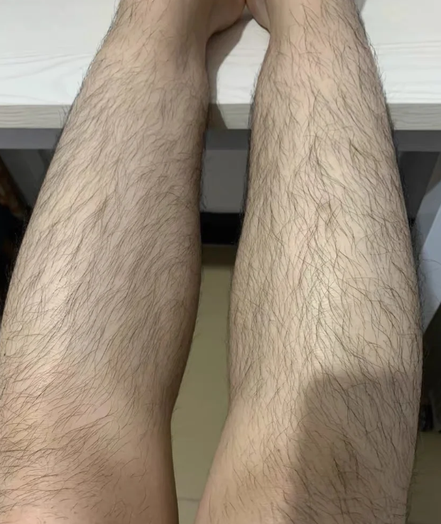 腿上汗毛太多了怎么去除