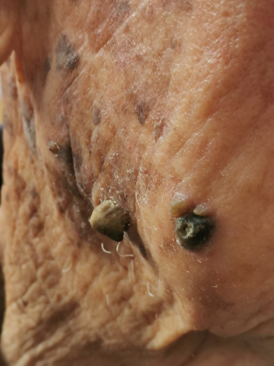 高龄老人的面部皮角症状.