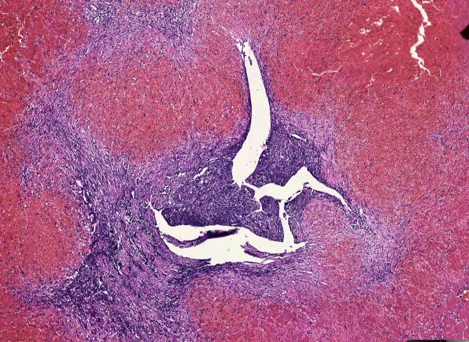 病理学实验切片,血栓机化和再通