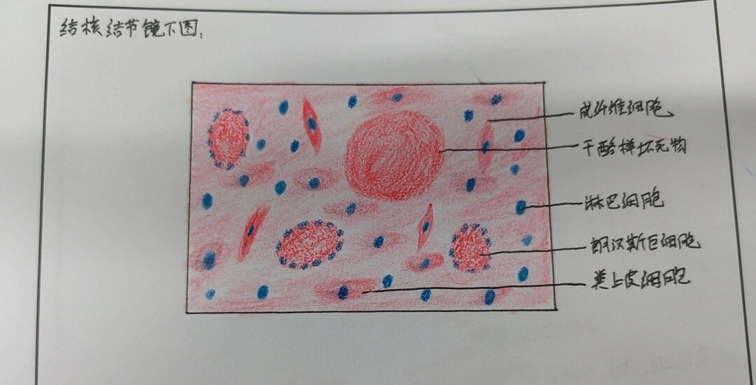 典型结核结节绘图