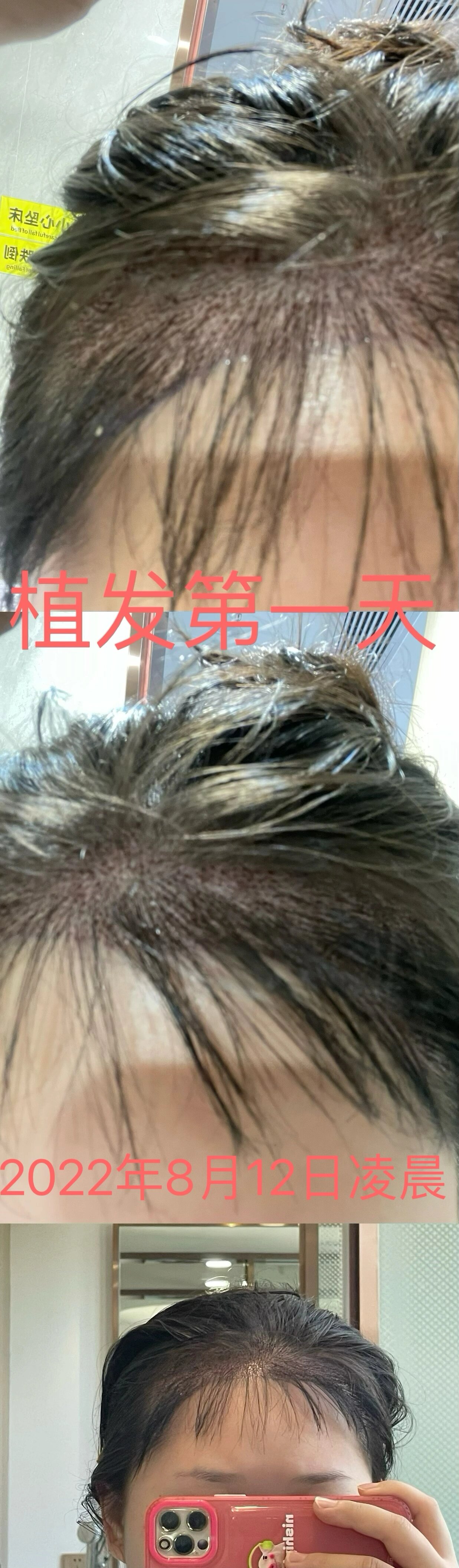 武汉正规大型植发(武汉正规大型植发医院排名)