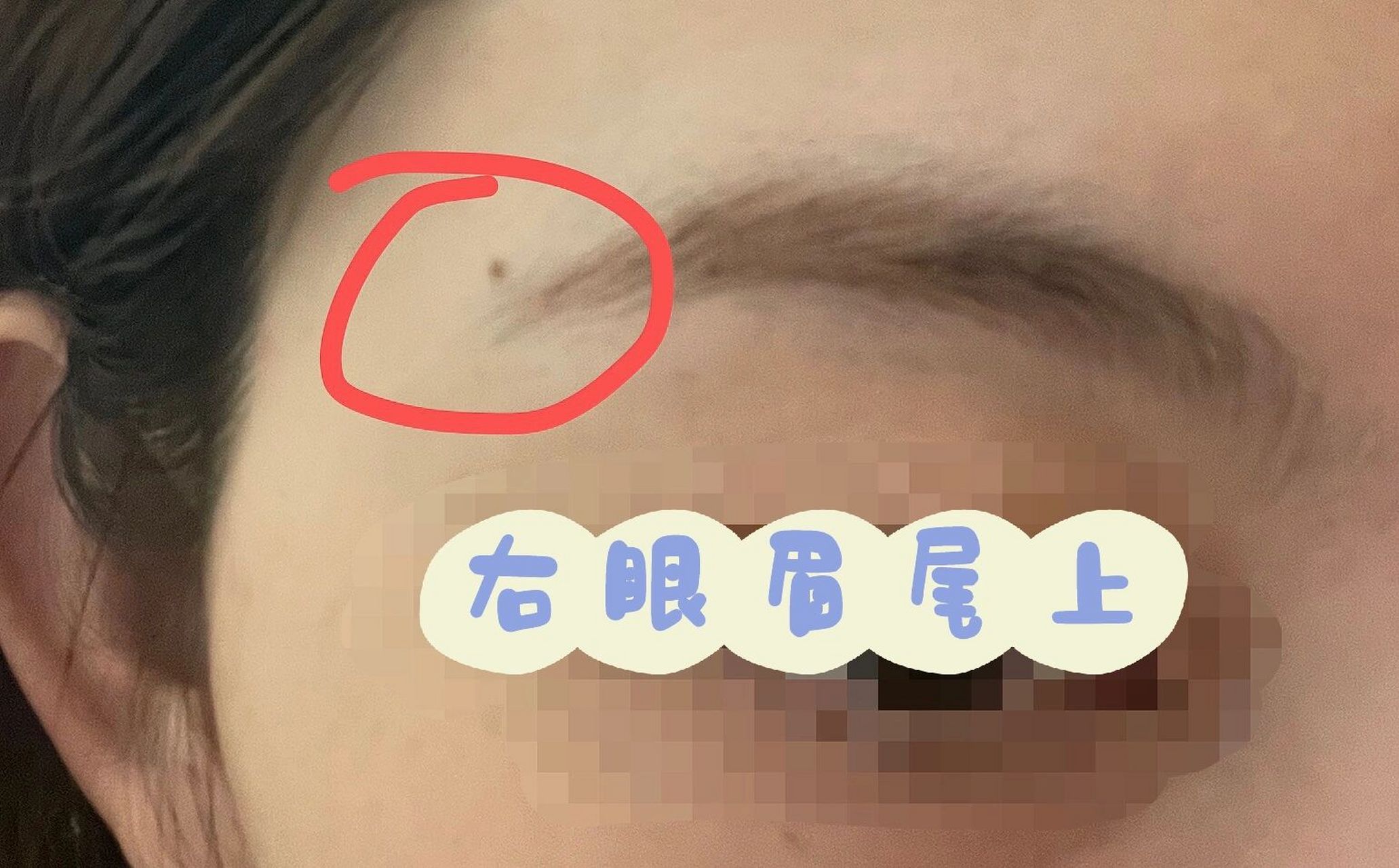 眉尾长痣 以前没有,这几年新长出来的 一开始还