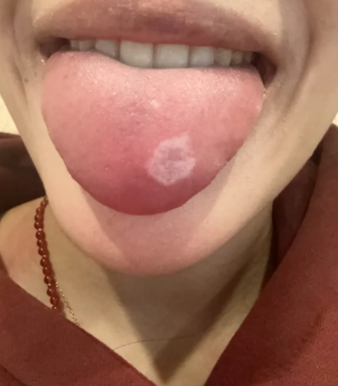 舌头出现白斑可能是舌白斑,鹅口疮或扁平苔藓引起的