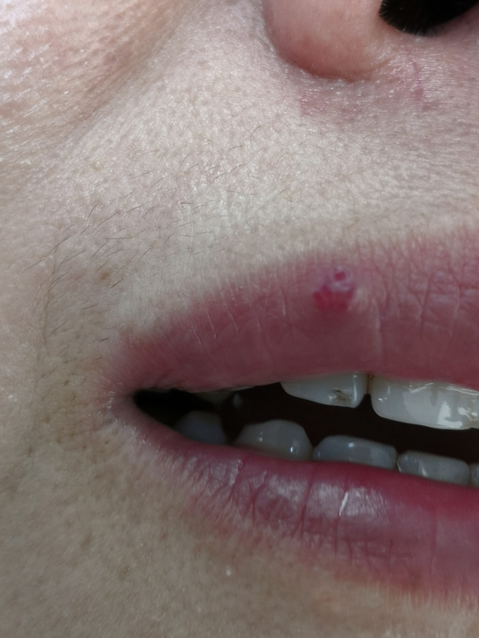 考虑化脓性肉芽肿#激光美容# 可以使用激光治疗去除#化脓性肉芽肿