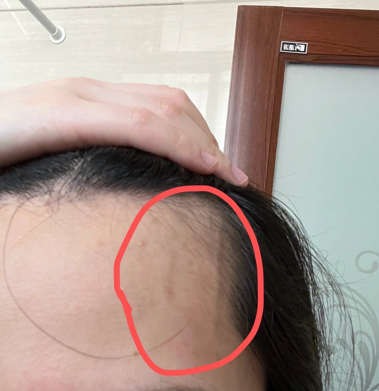 昨天熬夜后发现太阳穴青筋暴起是什么原因
