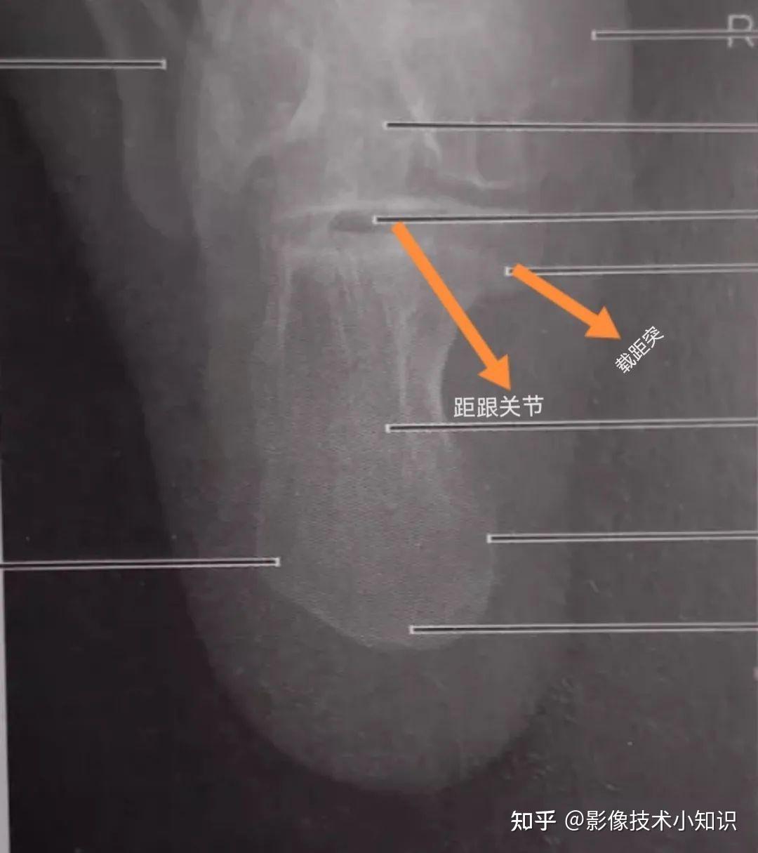 如何拍出标准的跟骨轴位片