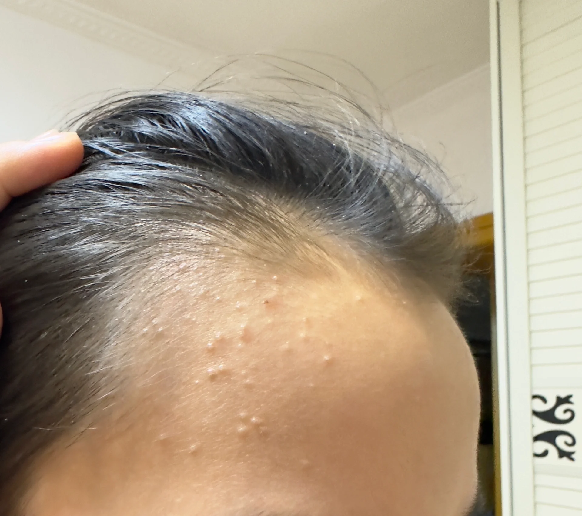 有懂的帮忙看一下 孩子额头上突然长了好多白色的小包包,也不疼也不痒
