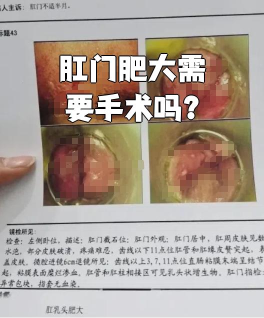 肛门肥大通常指的是肛乳头肥大,这是一种肛门常见的良性肿瘤