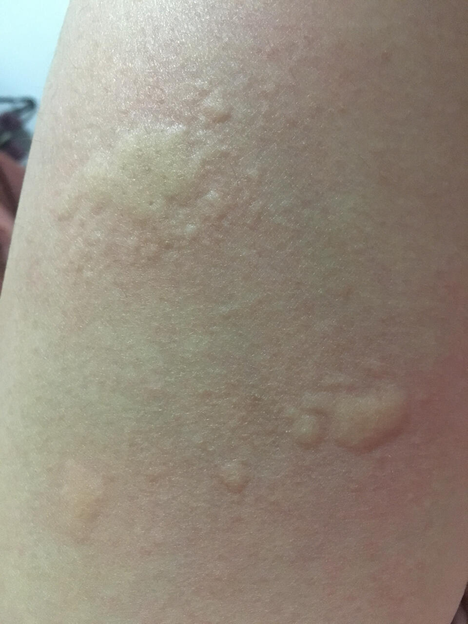 最近一段时间,大腿上经常起这种疙瘩,特别痒,一起就一片,起的快消的也