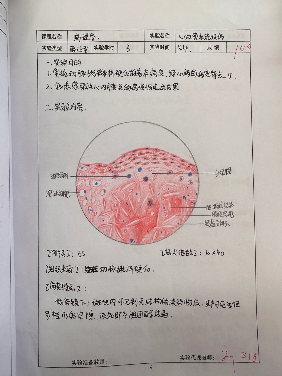 动脉粥样硬化切片图解图片