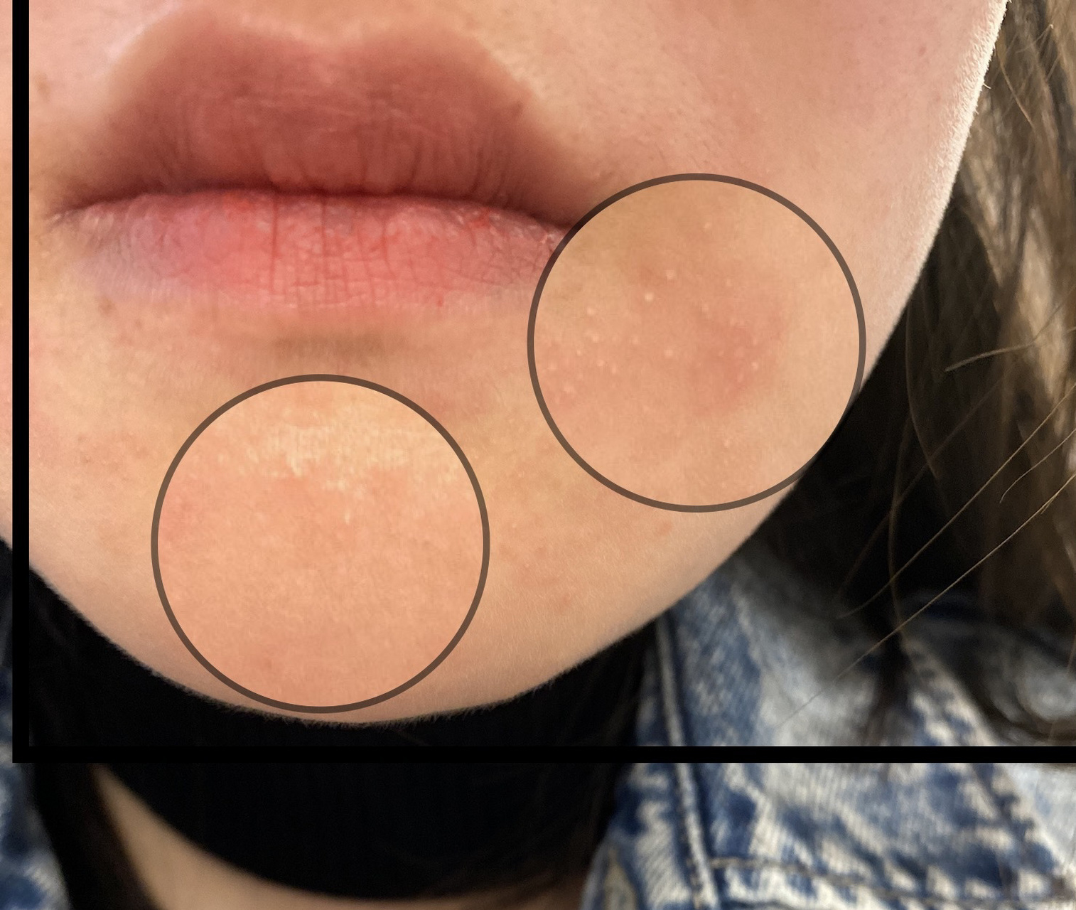 气温突然升高,嘴巴周围起了这样的小疹子,看起来带针尖似的脓包,随